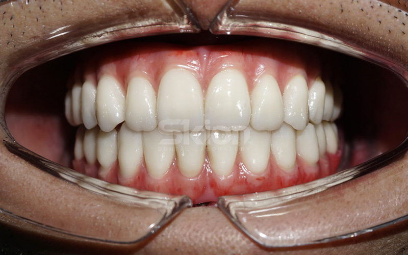 Phục hình lai với răng sứ Cercon ht ML