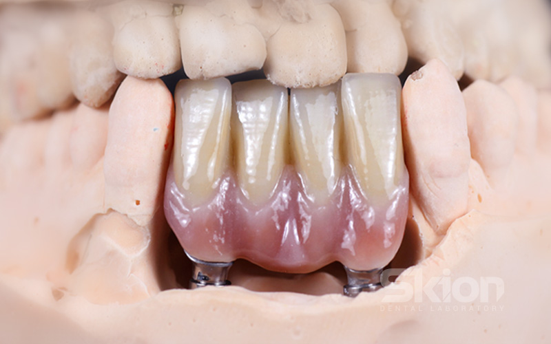 CẦU, MÃO ZIRCONIA TRÊN IMPLANT