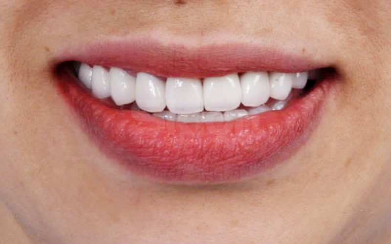 Răng sứ Emax là gì? Giải pháp phục hình thẩm mỹ đỉnh cao mà bác sĩ nào cũng nên biết.