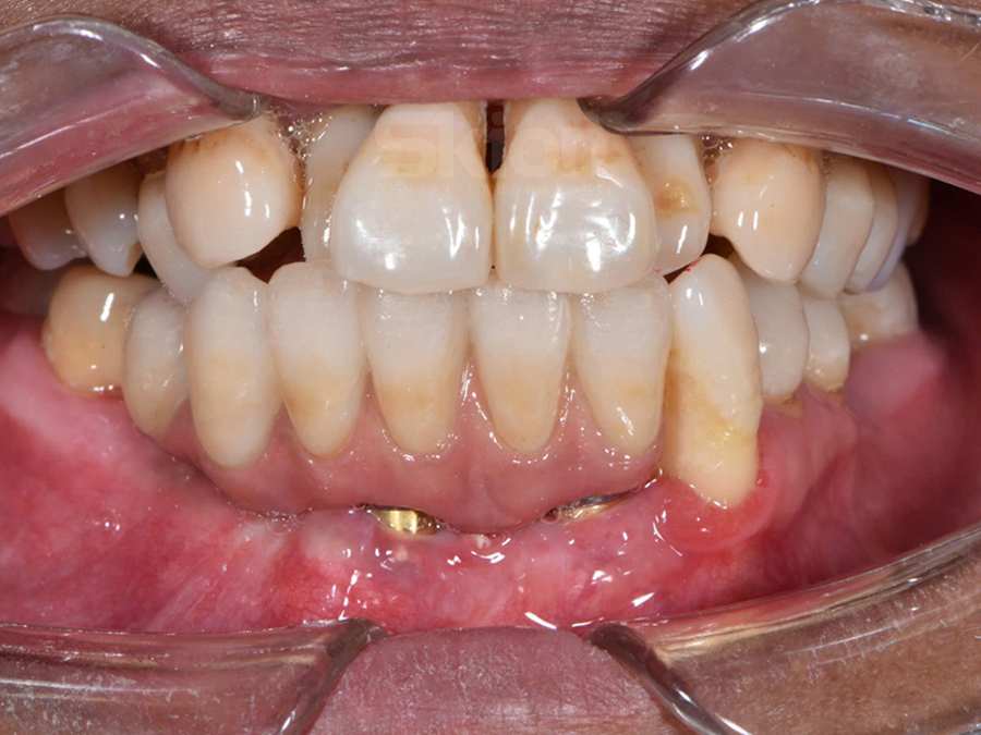 Răng sứ Zirconia trên implant