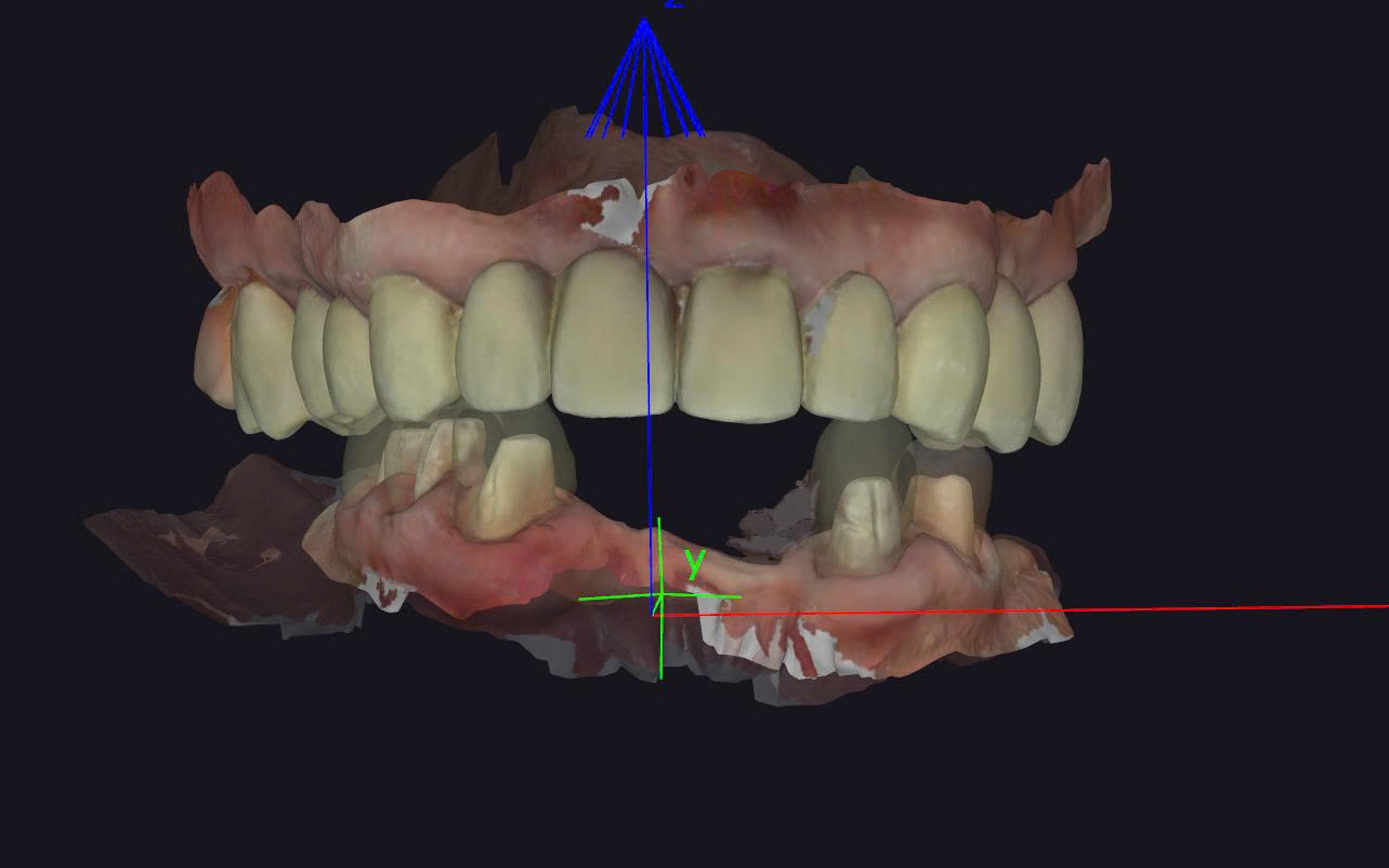 Khi nào bác sĩ nên trao đổi kỹ thuật với labo trước khi làm implant?