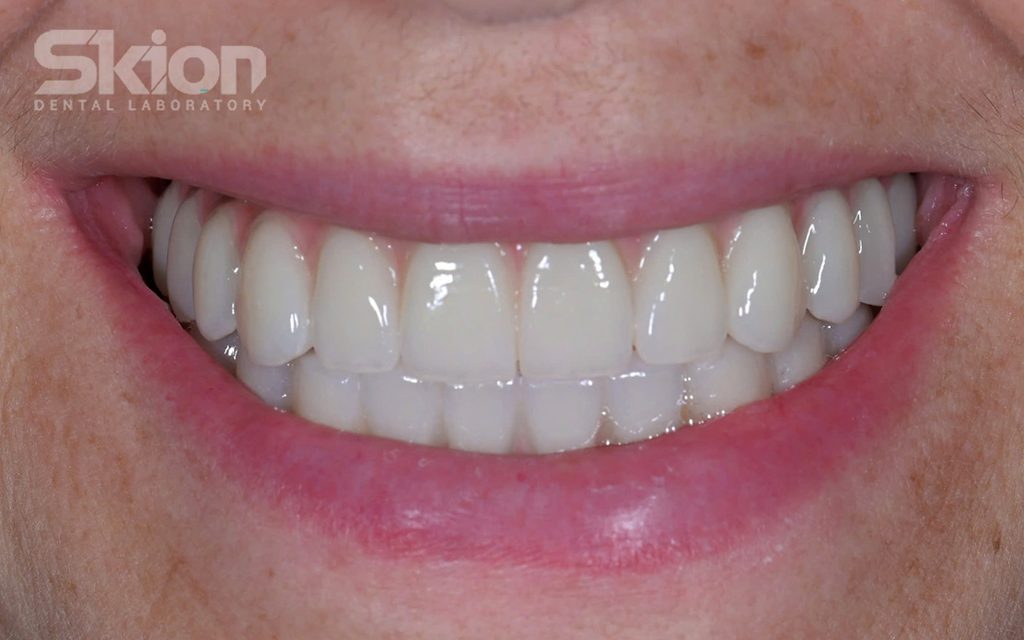 Phục hình toàn hàm Implant kết hợp Zirconia