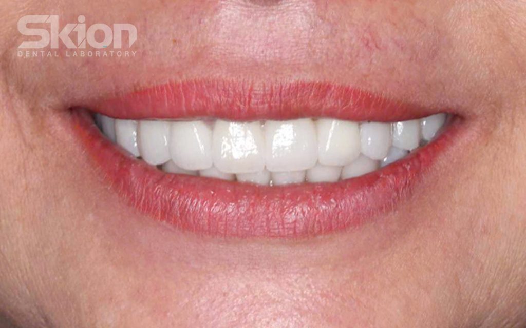 Cầu, mão Zirconia trên răng thật